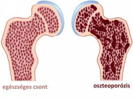 02_egeszseges_csont_oszteoporozis