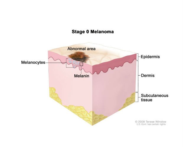 melanoma2