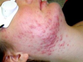 seborrhoeas dermatitis