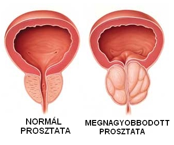 Prosztata vérrel